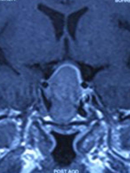 تومور بزرگ هیپوفیز در بانوی ۳۲ ساله