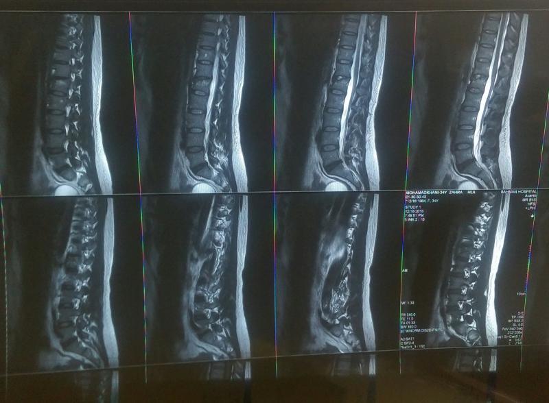 تصاویر ایکس ری در جراحی ستون فقرات