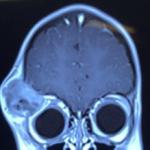 انواع تومور های قاعده ی جمجمه