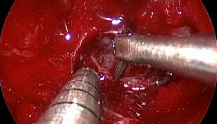 عمل جراحی تومور هیپوفیز