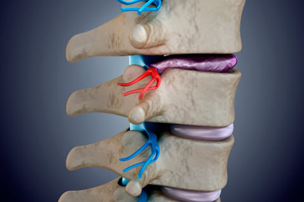 بیماری دیسک