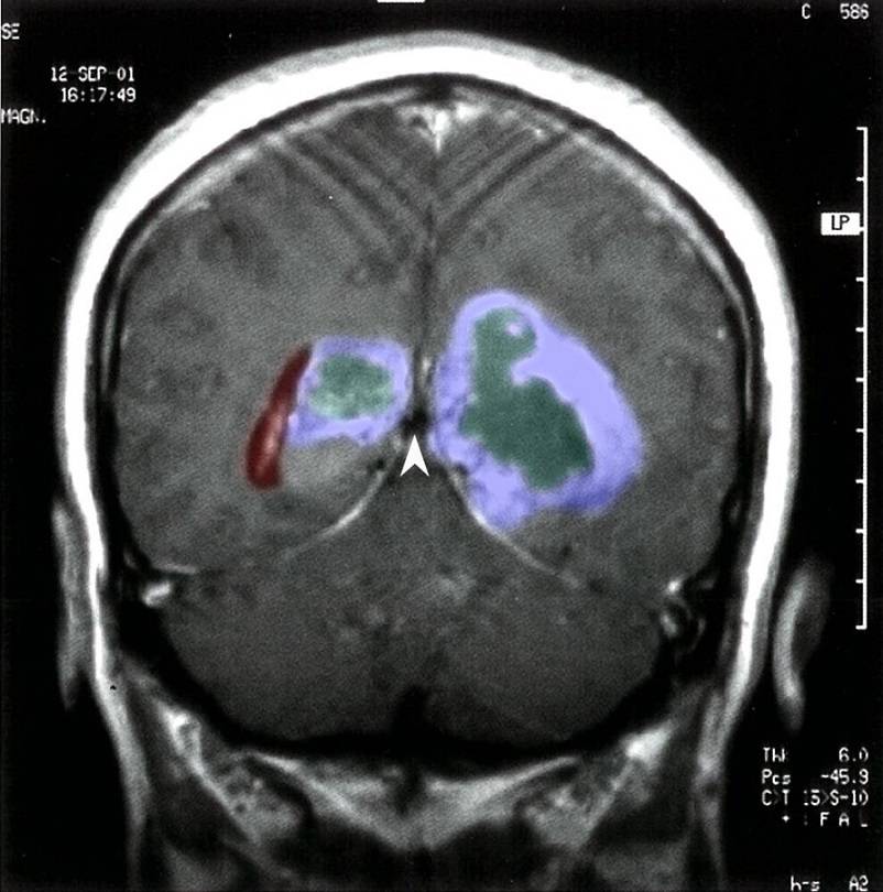 عکس تومور مغزی بدخیم