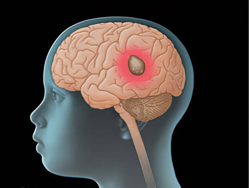 علائم تومور مغزی در کودکان چیست؟ - دکتر حسام عبدالحسین پور جراح مغز و ستون  فقرات