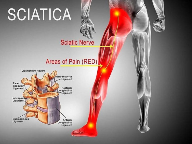 pin-on-sciatica