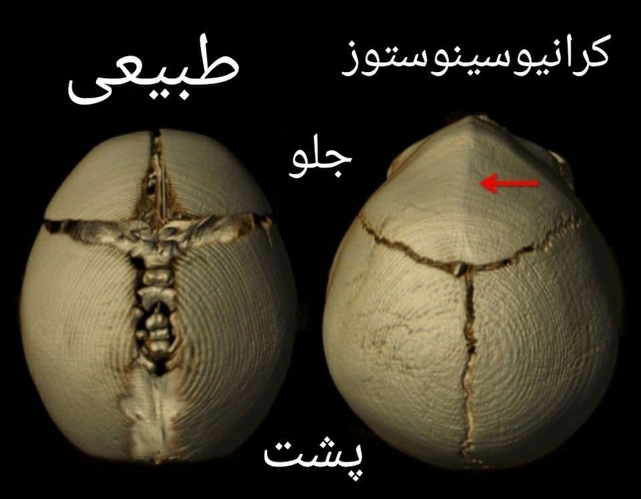 بیماری کرانیوسینوستوز