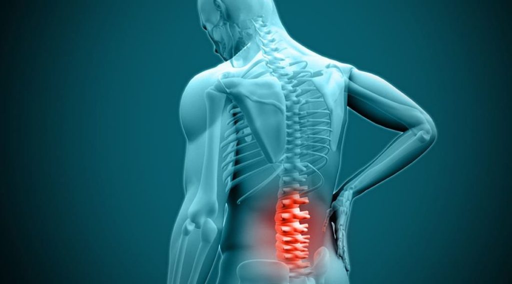 6 نکته درباره بیرون زدگی یا لغزش دیسک در قسمت پایین کمر