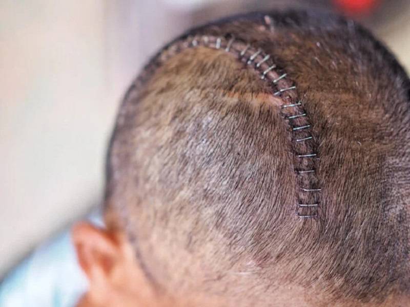 عمل باز تومور مغزی توسط جراح مغز و اعصاب