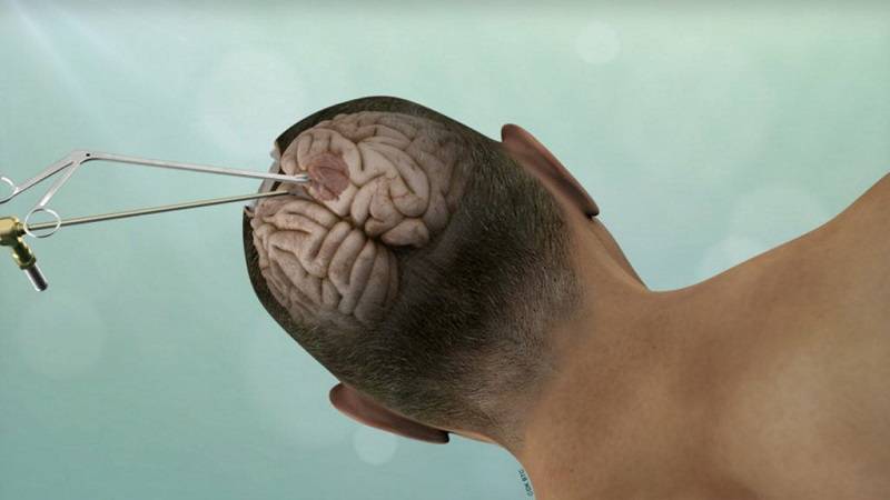 کرانیتوتومی یکی از روش های درمان تومور های مغزی