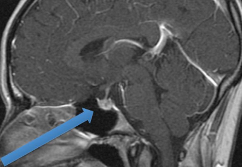 تومور هیپوفیز