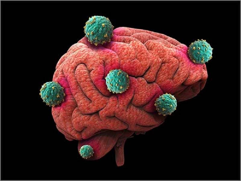 علت ایجاد تومور مغزی در افراد